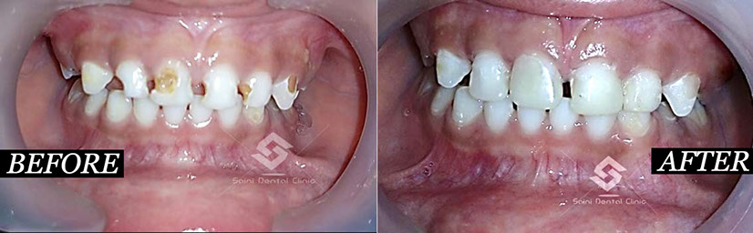 this is a Image of change of tooth 4 at saini dental clinic best dental clinic in jalandhar